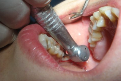 拔牙在一天中什么時間拔最好