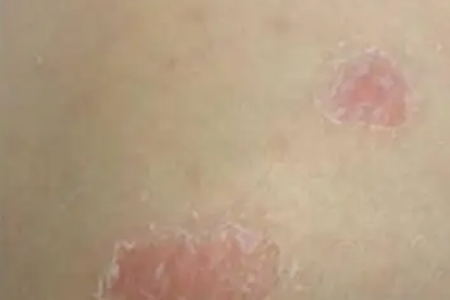 银屑病涂维生素e乳可以吗