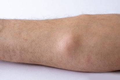 皮下脂肪瘤越长越大怎么办