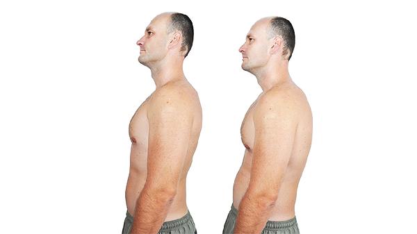 22岁脊柱侧弯还会恶化吗