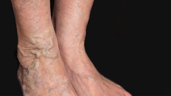 下肢浅静脉曲张是怎么回事