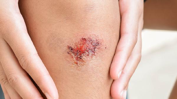 冻伤加烫伤伤口烂了怎么处理