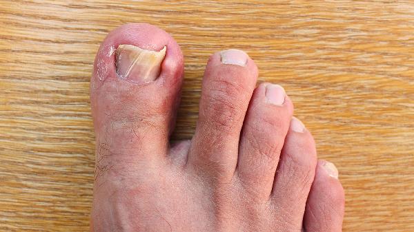 指甲上有褐色竖条纹是怎么回事