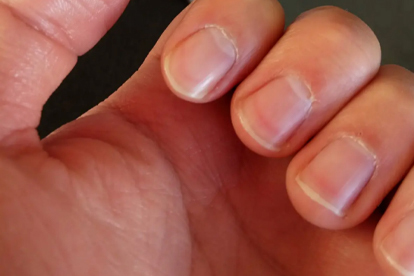 指甲上有褐色竖条纹是怎么回事