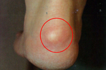 止点性跟腱炎有凸起怎么办