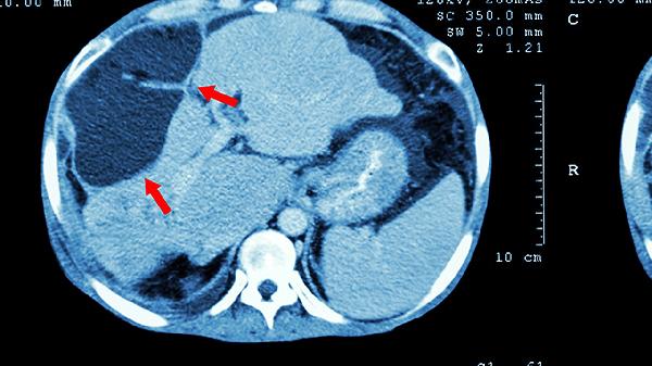 128层CT与普通CT的区别是什么