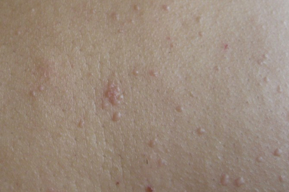 扁平疣怎么治疗 扁平疣的四个常用疗法分享