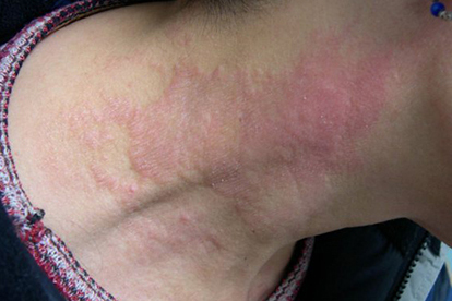 中医治疗慢性荨麻疹怎么才可以断根