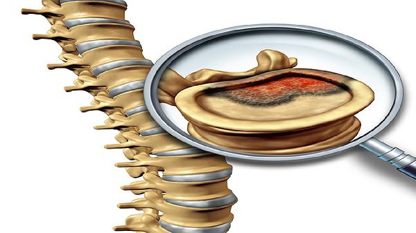 椎间盘膨出、硬膜囊受压严重吗