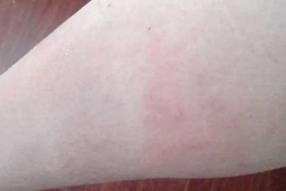 过敏原质控>100是什么意思