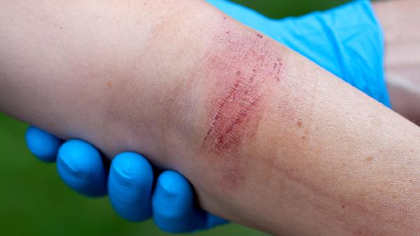 急性肺脓肿有哪些诱发因素