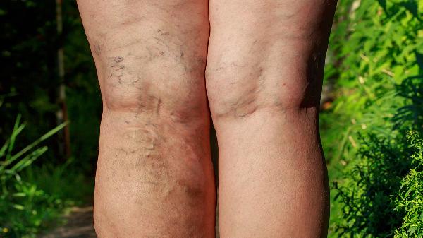 腿部静脉曲张是怎么引起的 3个原因导致腿部静脉曲张来袭