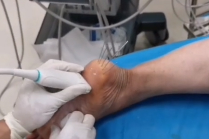 筋膜炎是怎么形成的 四个原因促使筋膜炎是形成