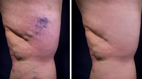 静脉曲张引起的湿疹怎么治疗