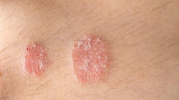 头皮型银屑病吃蒲公英管用吗 介绍缓解头皮型银屑病的小方法