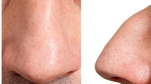 驼峰鼻矫正手术有什么风险