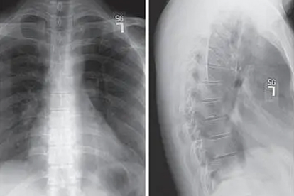 胸椎8压缩性骨折最好的治疗方法