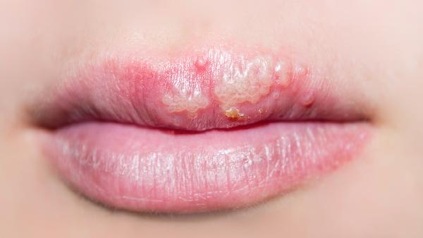 嘴唇腫脹是什么病 這些疾病會導(dǎo)致嘴唇腫脹