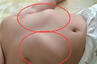 雞胸和漏斗胸一樣嗎？如何區(qū)分兩者