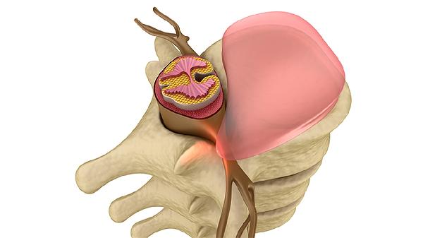 脊柱压缩性骨折严重吗 认识脊柱压缩性骨折带来的危害