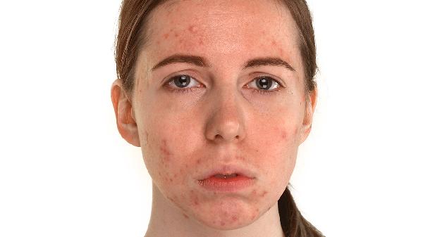 患者造影剂过敏导致喉头水肿患者应如何处理