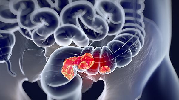 骨骼肿块患者的饮食宜忌有哪些