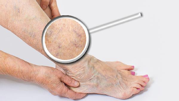 大腿根部血管瘤有什么症状 详述大腿根部血管瘤的3个症状