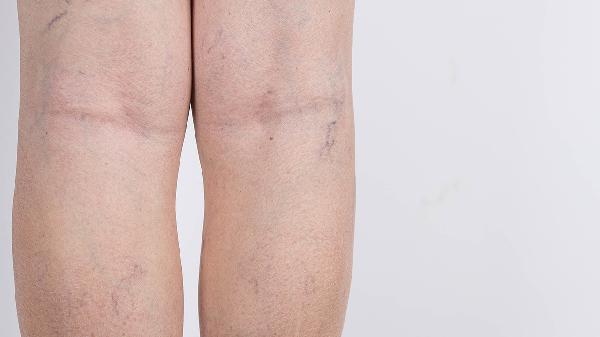 大腿根部血管瘤有什么症状 详述大腿根部血管瘤的3个症状