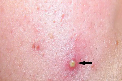 糠秕孢子菌毛囊炎最好的治疗方法是什么