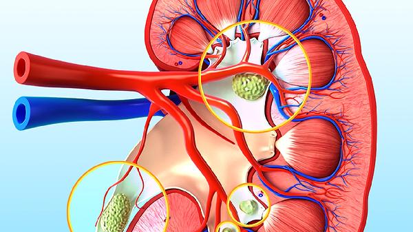 肾囊肿怎样治疗最好 治疗肾囊肿须手术吗