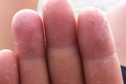 手癣怎么治 推荐治疗手癣的6个方法