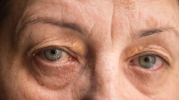 老年人眼睛发干怎么办 传授五个小方法解决眼干问题