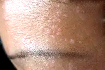 扁平疣一定要治疗吗 不治扁平疣的3危害不容轻视