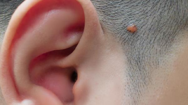 如何区分骨巨细胞瘤和骨化纤维瘤  骨巨细胞瘤和骨化纤维瘤有哪些不同