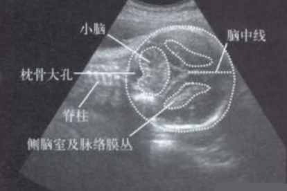 小脑延髓池增宽的原因有哪些