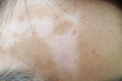 老年性白斑需要做什么检查