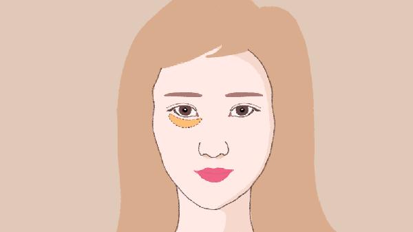 填充泪沟2个月像眼袋正常吗