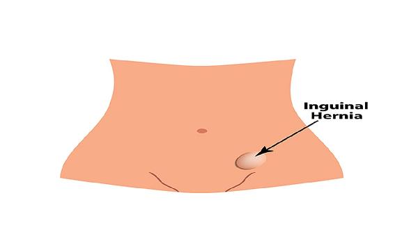 滑动型食管裂孔疝有哪些并发症