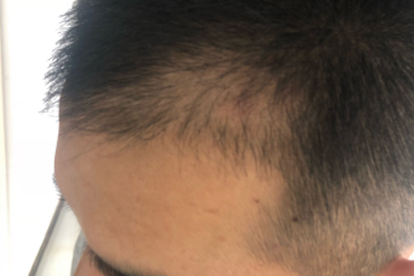 脂溢性脱发常见的症状表现盘点 详细讲解脂溢性脱发3表现