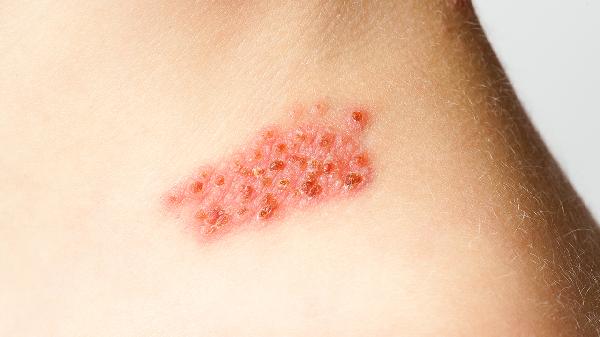 皮肤爱出油是什么原因