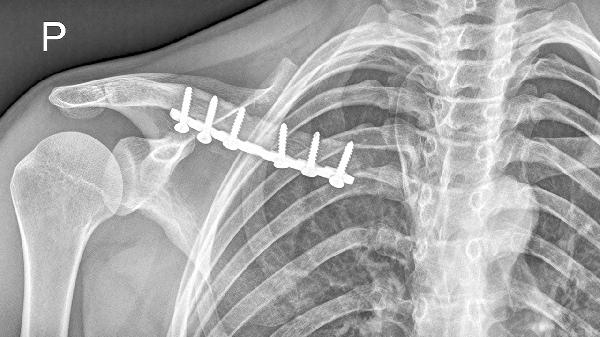 锁骨下动脉堵塞介入手术后怎么护理