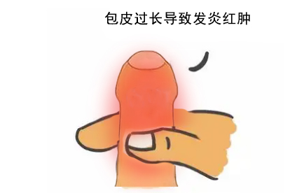 包皮过长的人一定要做环切手术吗