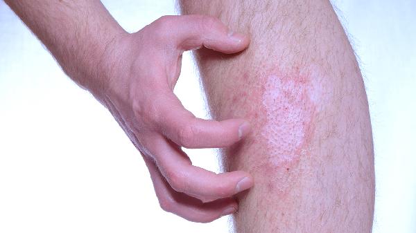 伤口愈合后周边起小丘疹怎么回事,怎么办