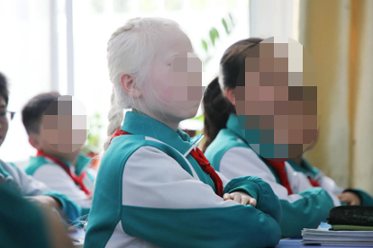 白化病治疗方法是什么