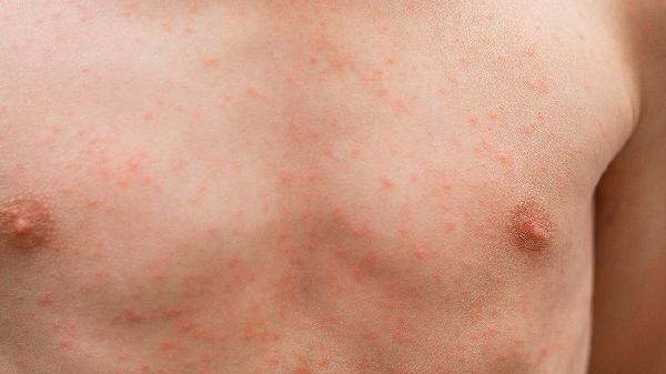 医生分析多名荨麻疹患者，惊讶发现：患荨麻疹的人，多有4大恶习