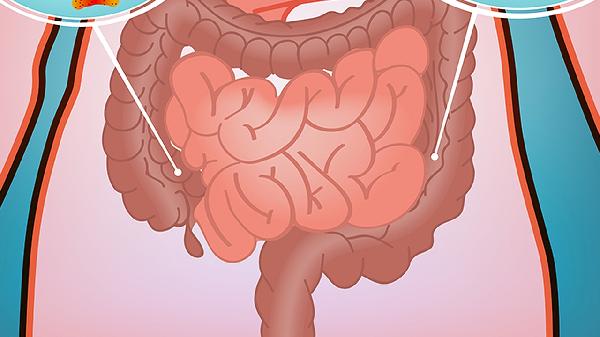 体检发现胃息肉、肠息肉严重吗？医生：这3个地方长息肉要警惕