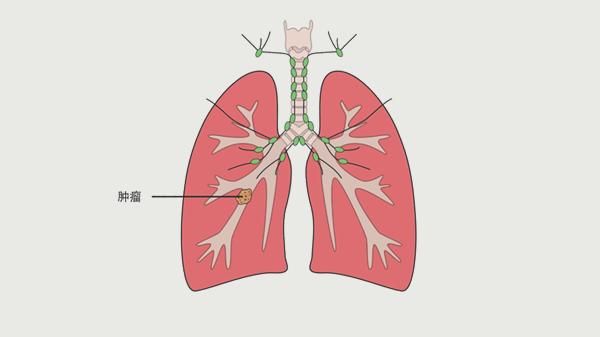 都是肺癌，有人半年就去世，有人却活了几十年，医生告诉你为什么