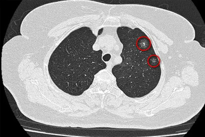 肺癌和散步有关？医生提醒：不想肺部出问题，散步时多注意这几点