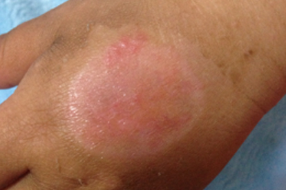 低温蜡烛会不会烫伤皮肤呢