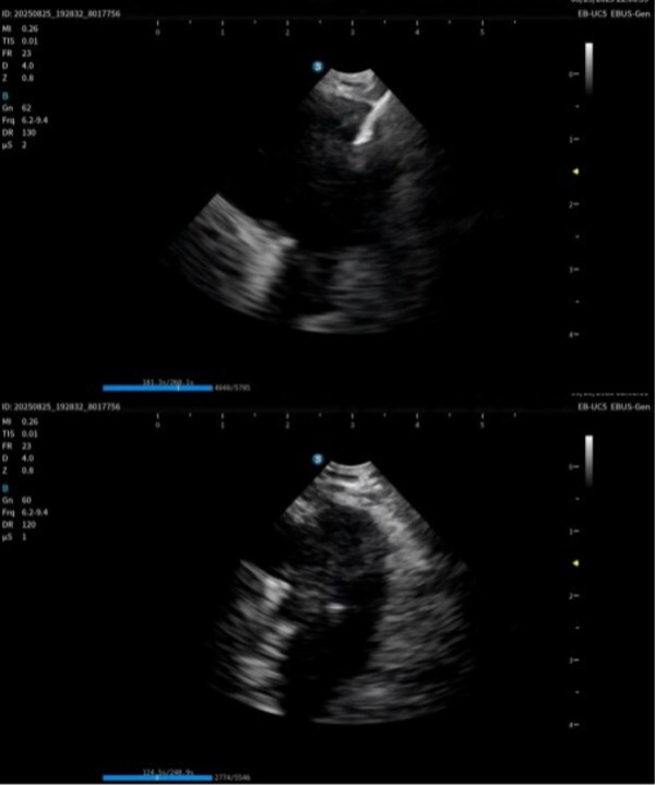 国产创新出海：开立医疗超声电子支气管内窥镜系统获欧盟CE(MDR)认证